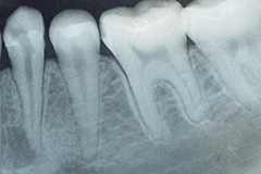 Removal Of Wisdom Teeth in Fort Mill